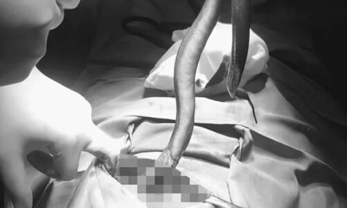 momenti i tmerrshem kirurget nxjerrin nje ngjale te gjalle nga barku i nje burri pasi i rreshqiti permes foto